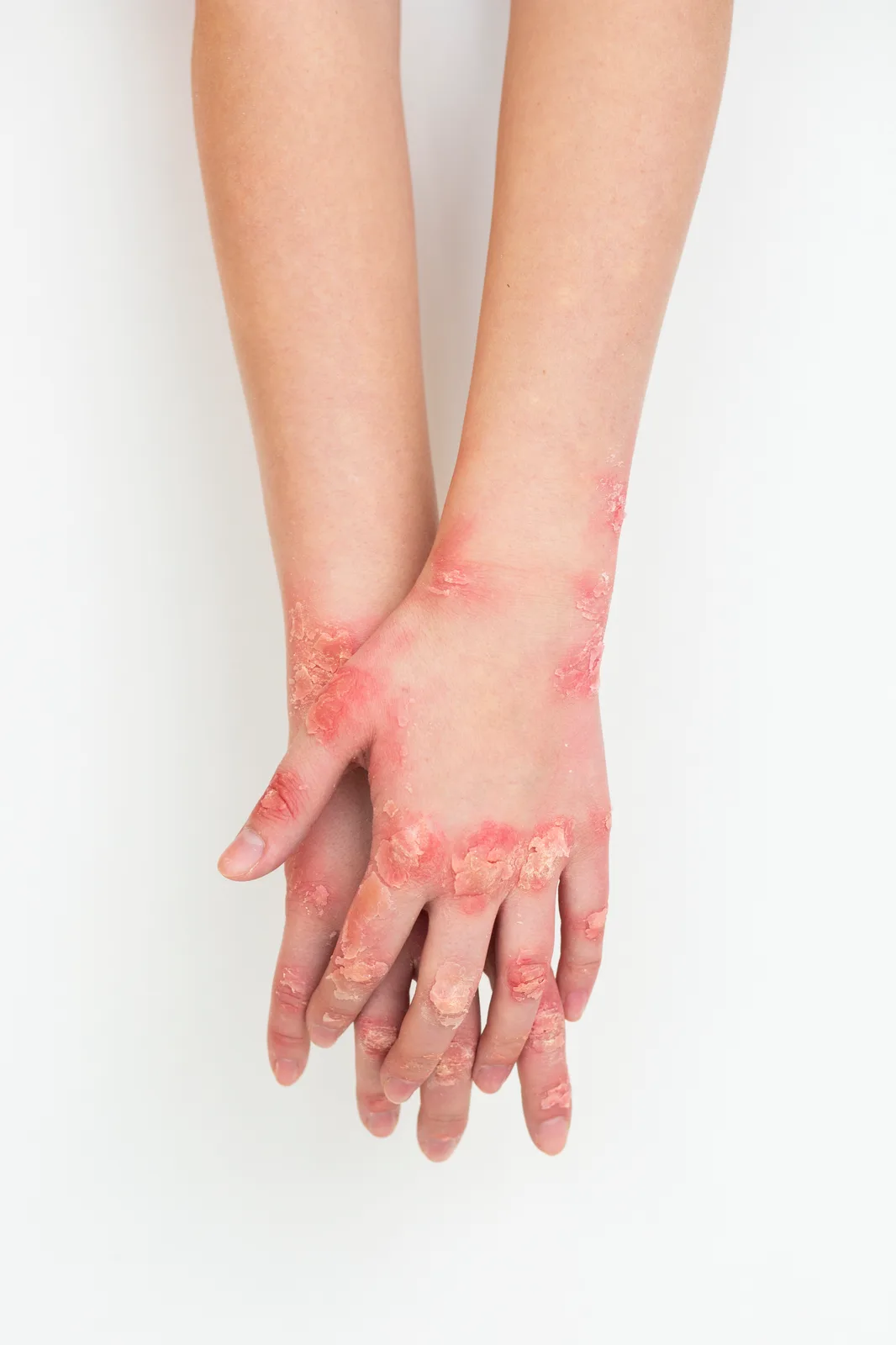 الصدفية (Psoriasis): الأعراض، الأنواع، وأحدث العلاجات — تعريف بمرض الصدفية المناعي، أنواعه المختلفة، وأحدث العلاجات المتاحة لتحسين الأعراض.