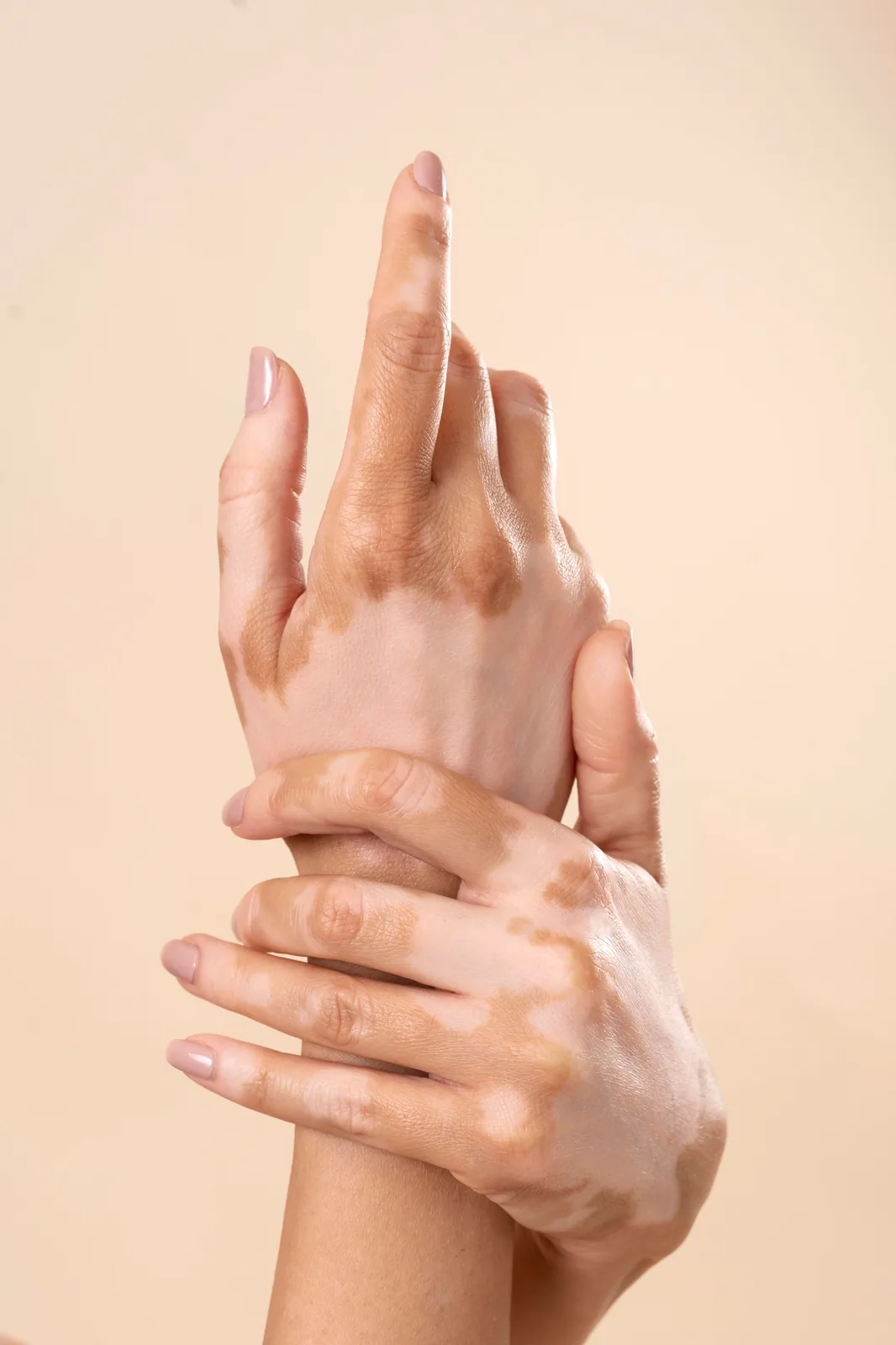 البهاق (Vitiligo): الأسباب وأحدث طرق العلاج — معلومات عن مرض البهاق وأسبابه المناعية مع استعراض طرق العلاج الحديثة والخيارات الجراحية.
